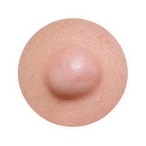 Petit lipome