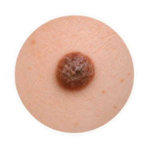 Naevus (grain de beauté)