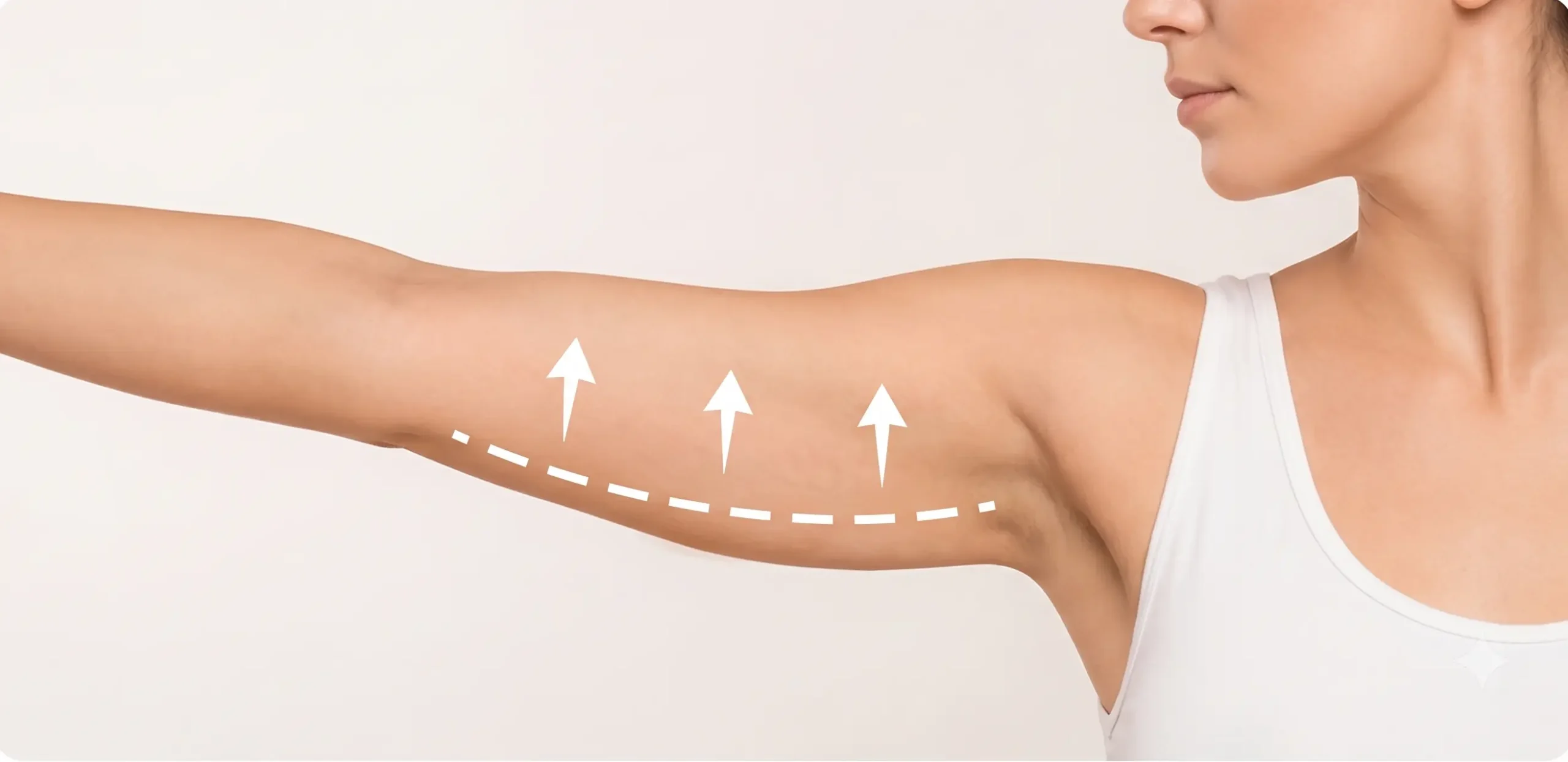 Lifting des bras